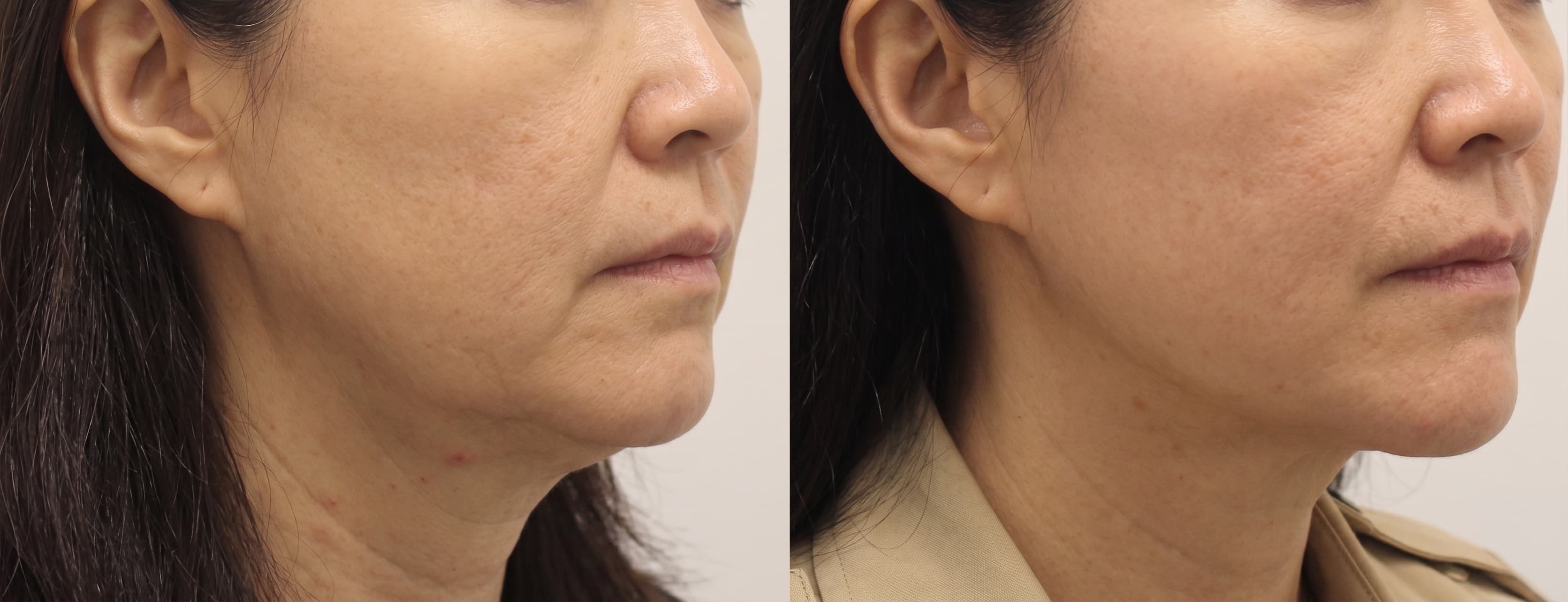 before-after