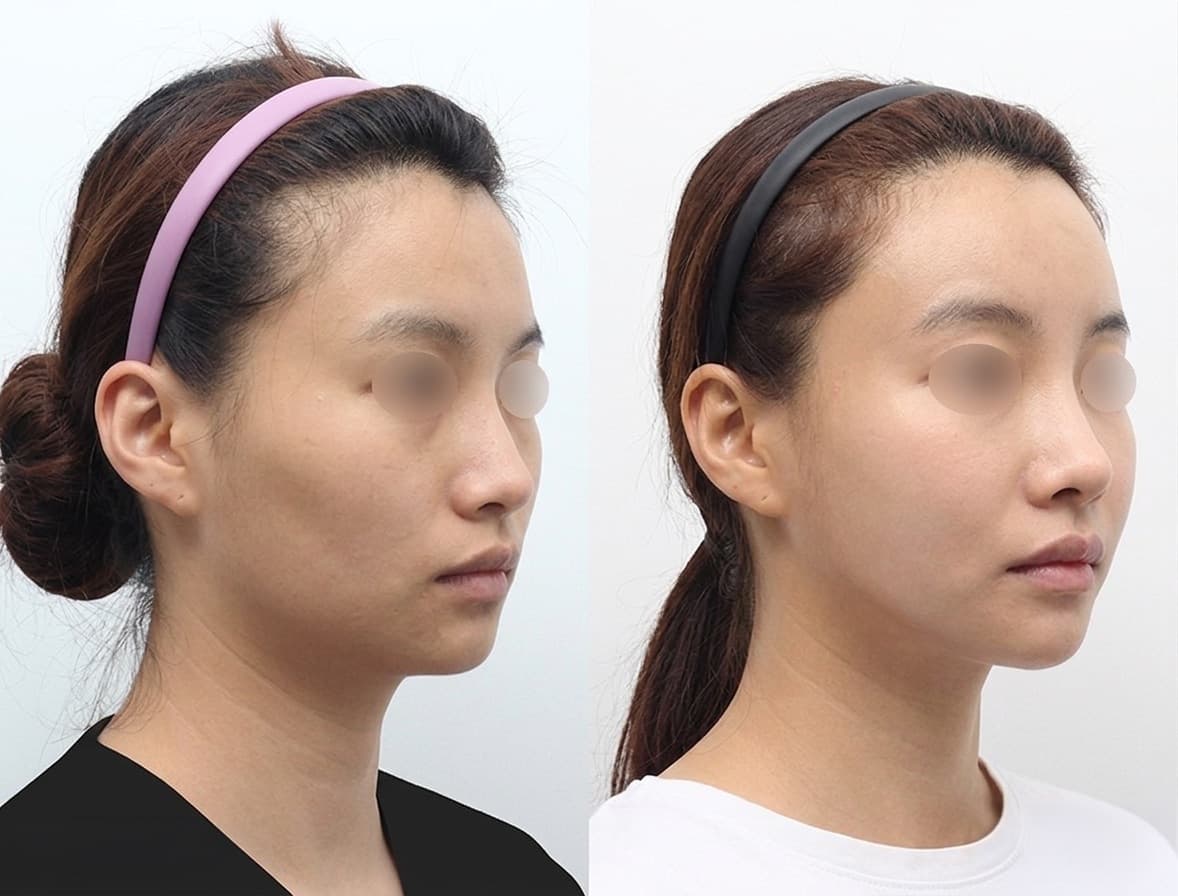 before-after