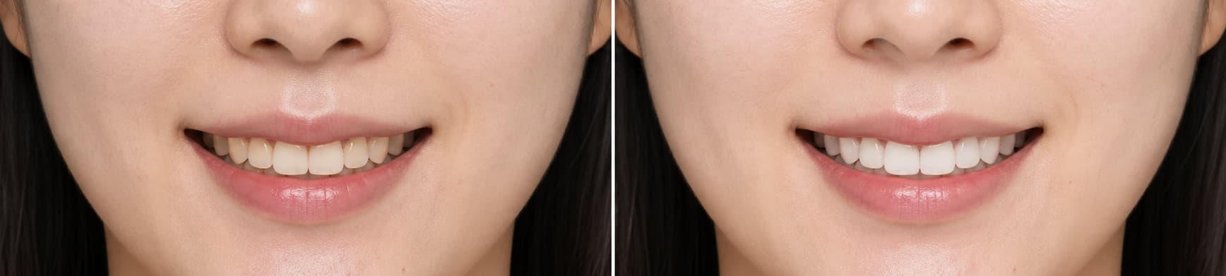 before-after