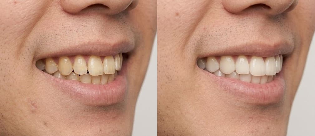 before-after