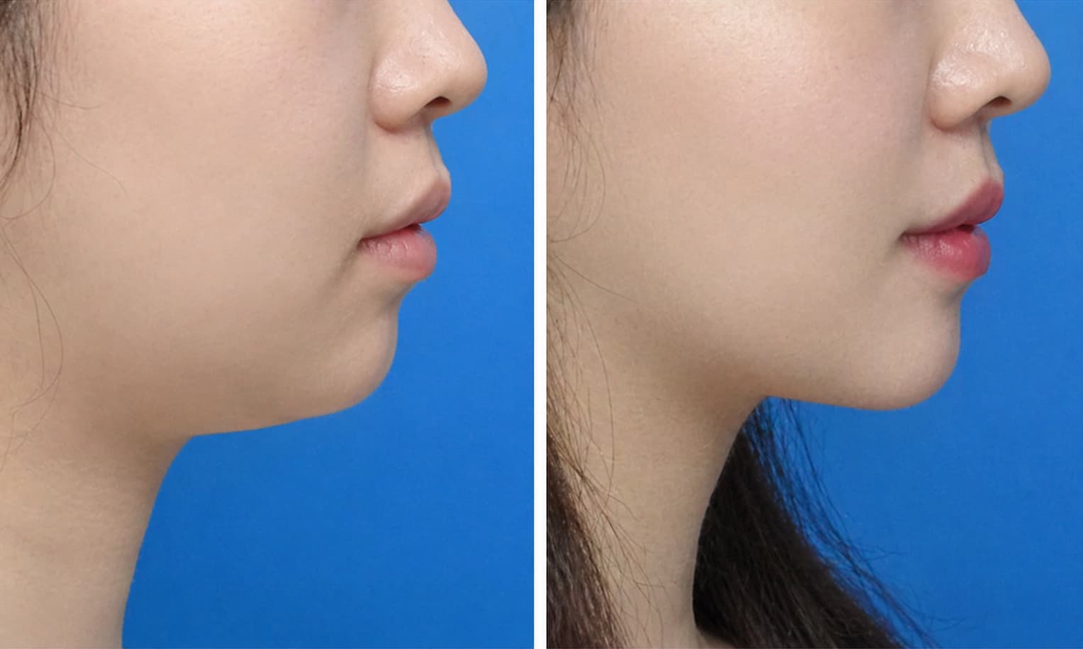 before-after