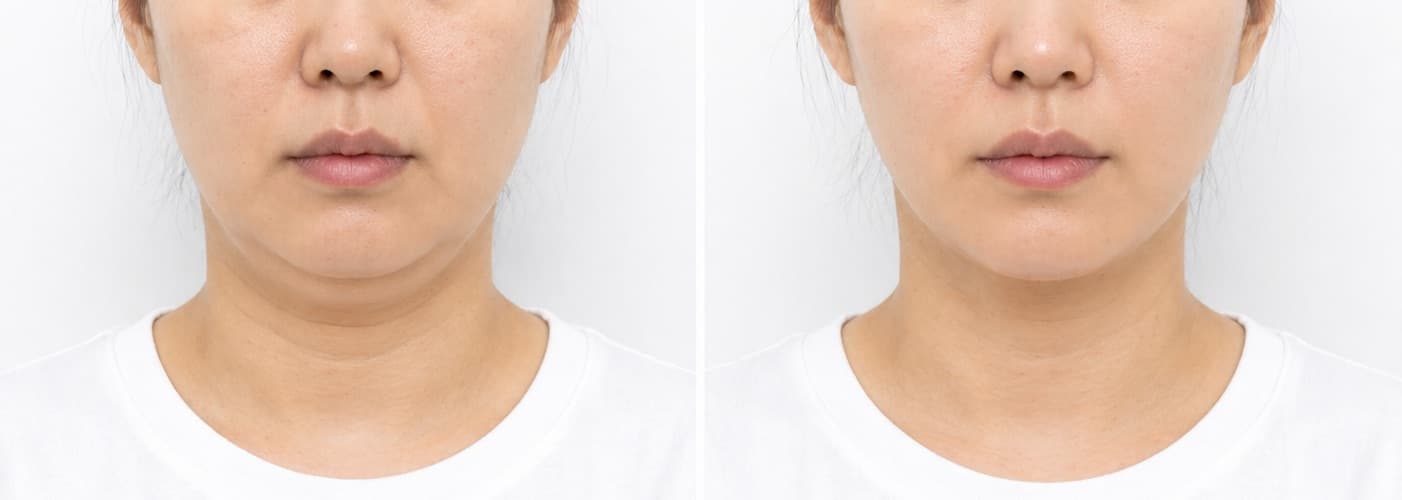 before-after