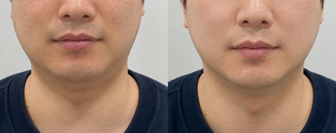 before-after