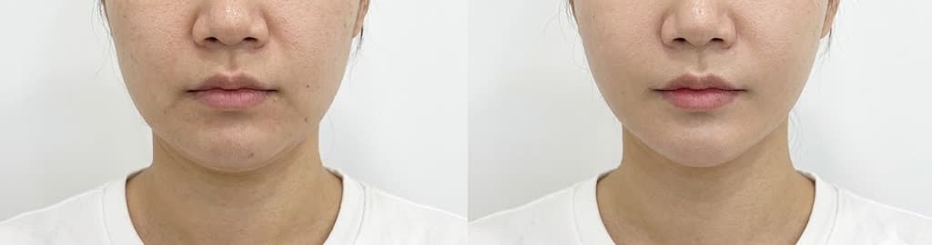 before-after