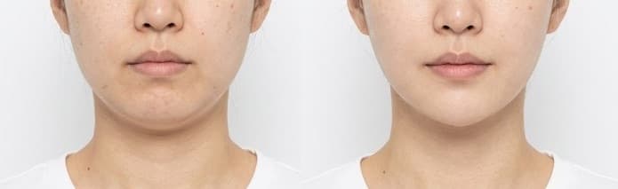 before-after