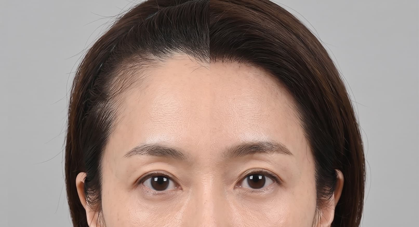 M字毛髪移植
